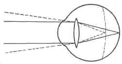 Diagram illustrating myopia or near-sightedness