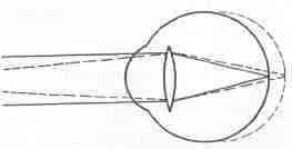 Diagram illustrating hypermetropia or far sightedness