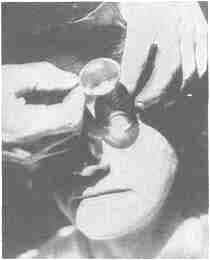 Concentrating the rays of the sun upon the eyeball with a lens or burning glass